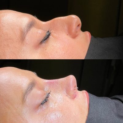 Rhinoplasty for Nasal Tip Ptosis, Wide Tip, Dorsal Hump, and Low Radix