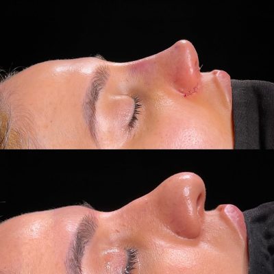 Rhinoplasty in a Patient with a Large, Thick-Skinned Nose
