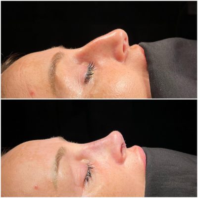 female revision rhinoplasty before and after