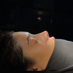 African American Rhinoplasty Before and After 1 African American Rhinoplasty Before and After