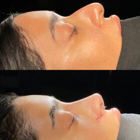 African American Rhinoplasty Before and After 2 African American Rhinoplasty Before and After