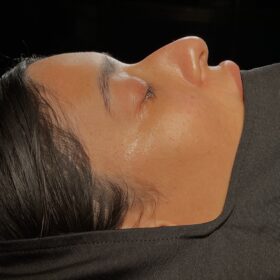 African American Rhinoplasty Before and After 3 African American Rhinoplasty Before and After