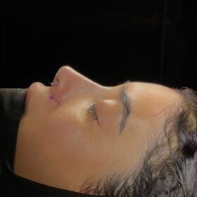 African American Rhinoplasty Before and After 4 African American Rhinoplasty Before and After