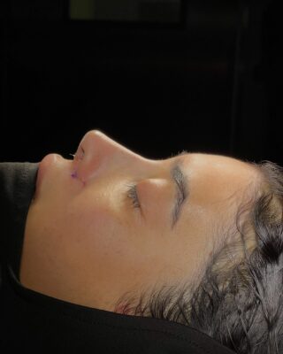 African American Rhinoplasty Before and After