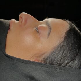 African American Rhinoplasty Before and After 5 African American Rhinoplasty Before and After