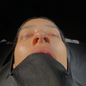 African American Rhinoplasty Before and After 6 African American Rhinoplasty Before and After