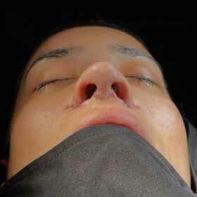 African American Rhinoplasty Before and After 7 African American Rhinoplasty Before and After