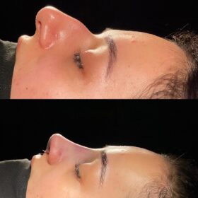 Aquiline Nose Rhinoplasty Before and After