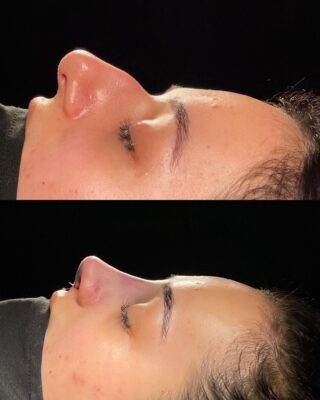 Aquiline Nose Rhinoplasty Before and After