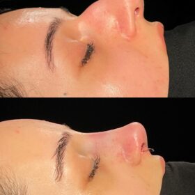 Aquiline Nose Rhinoplasty Before and After