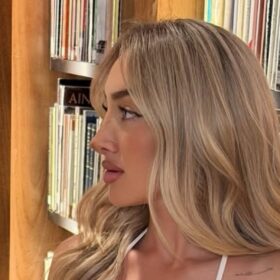 Blonde Female Revision Rhinoplasty Long Term Result 2 Blonde Female Revision Rhinoplasty Long-Term Result