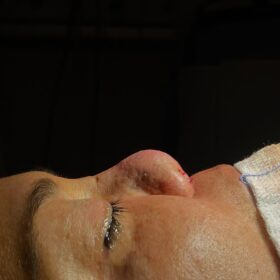 Extreme Revision Rhinoplasty Before and After 1 Extreme Revision Rhinoplasty Before and After