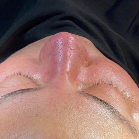 Extreme Revision Rhinoplasty Before and After 3 Extreme Revision Rhinoplasty Before and After