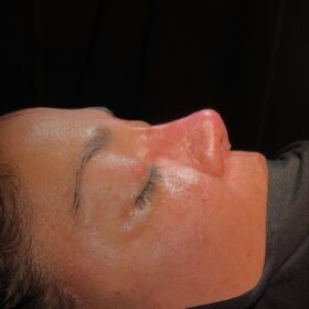 Extreme Revision Rhinoplasty Before and After 4 Extreme Revision Rhinoplasty Before and After