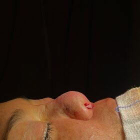 Extreme Revision Rhinoplasty Before and After 5 Extreme Revision Rhinoplasty Before and After