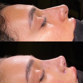 Female Primary Rhinoplasty Before and After Photos 1 Female Primary Rhinoplasty Before and After Photos