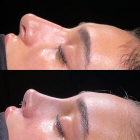 Female Primary Rhinoplasty Before and After Photos 2 Female Primary Rhinoplasty Before and After Photos