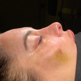 Female Revision Rhinoplasty Before and After