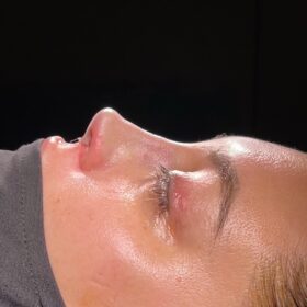 Female Revision Rhinoplasty Before and After