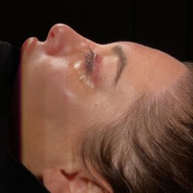 Female Revision Rhinoplasty Before and After 4 Female Revision Rhinoplasty Before and After