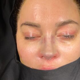 Female Revision Rhinoplasty Before and After 5 Female Revision Rhinoplasty Before and After
