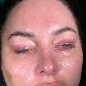 Female Revision Rhinoplasty Before and After 6 Female Revision Rhinoplasty Before and After