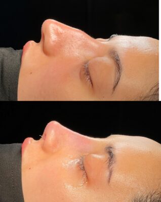 Natural Female Rhinoplasty Before and After
