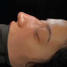 Natural Female Rhinoplasty Before and After