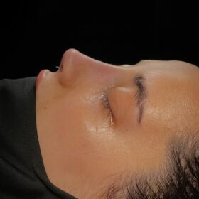 Natural Female Rhinoplasty Before and After