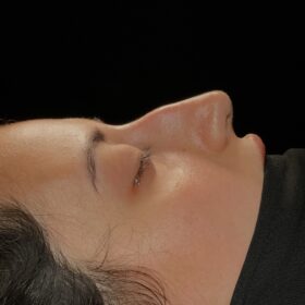 Natural Female Rhinoplasty Before and After 4 Natural Female Rhinoplasty Before and After