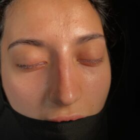 Natural Female Rhinoplasty Before and After 6 Natural Female Rhinoplasty Before and After