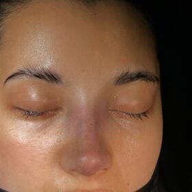 Natural Female Rhinoplasty Before and After 7 Natural Female Rhinoplasty Before and After