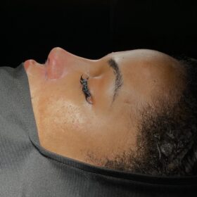 Natural-Looking Rhinoplasty in Turkey from USA