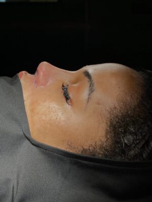 Natural-Looking Rhinoplasty in Turkey from USA