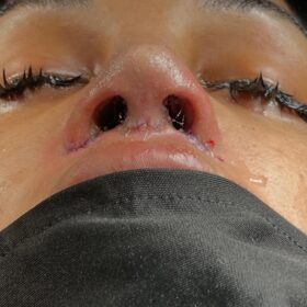 Natural-Looking Rhinoplasty in Turkey from USA