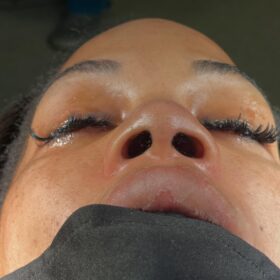 Natural Looking Rhinoplasty in Turkey from USA 4 Natural-Looking Rhinoplasty in Turkey from USA