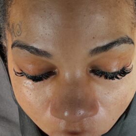 Natural Looking Rhinoplasty in Turkey from USA 5 Natural-Looking Rhinoplasty in Turkey from USA