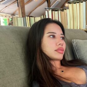 Thick Skin Female Open Rhinoplasty Result