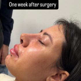 Thick Skin Female Open Rhinoplasty Result 5 Thick Skin Female Open Rhinoplasty Result