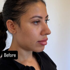 Thick Skin Female Open Rhinoplasty Result 6 Thick Skin Female Open Rhinoplasty Result